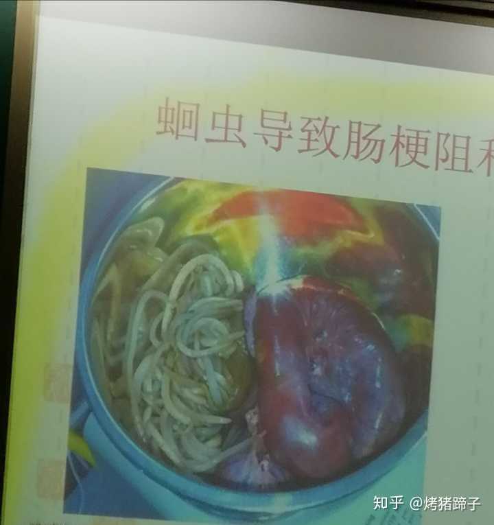 蛔虫导致肠梗阻,不想说什么,第一眼以为是豆芽,看清楚了饭都不想吃了.