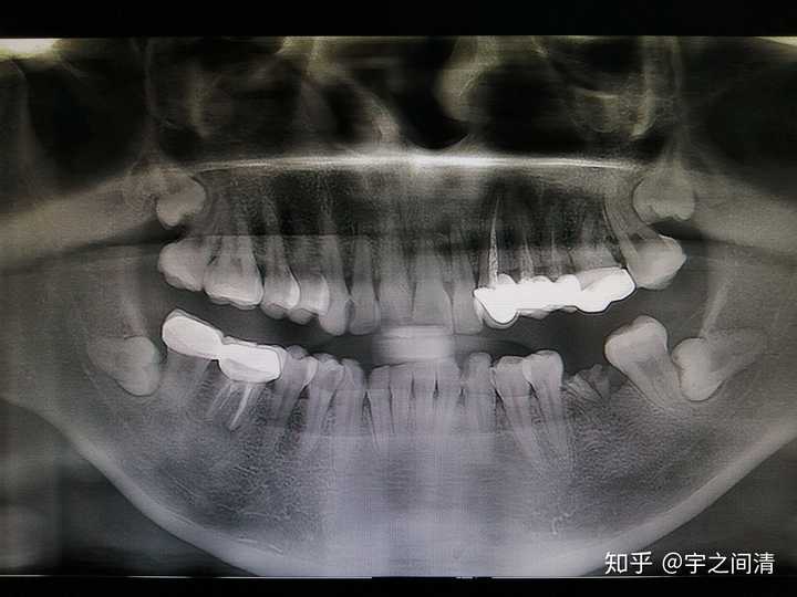 5.24号拍的片子,智齿们还是发生了些许变化的