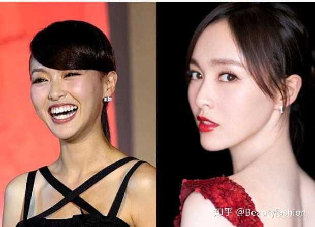 如何改善嘴凸?