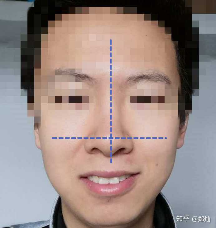 脸歪嘴歪怎么改善呢?