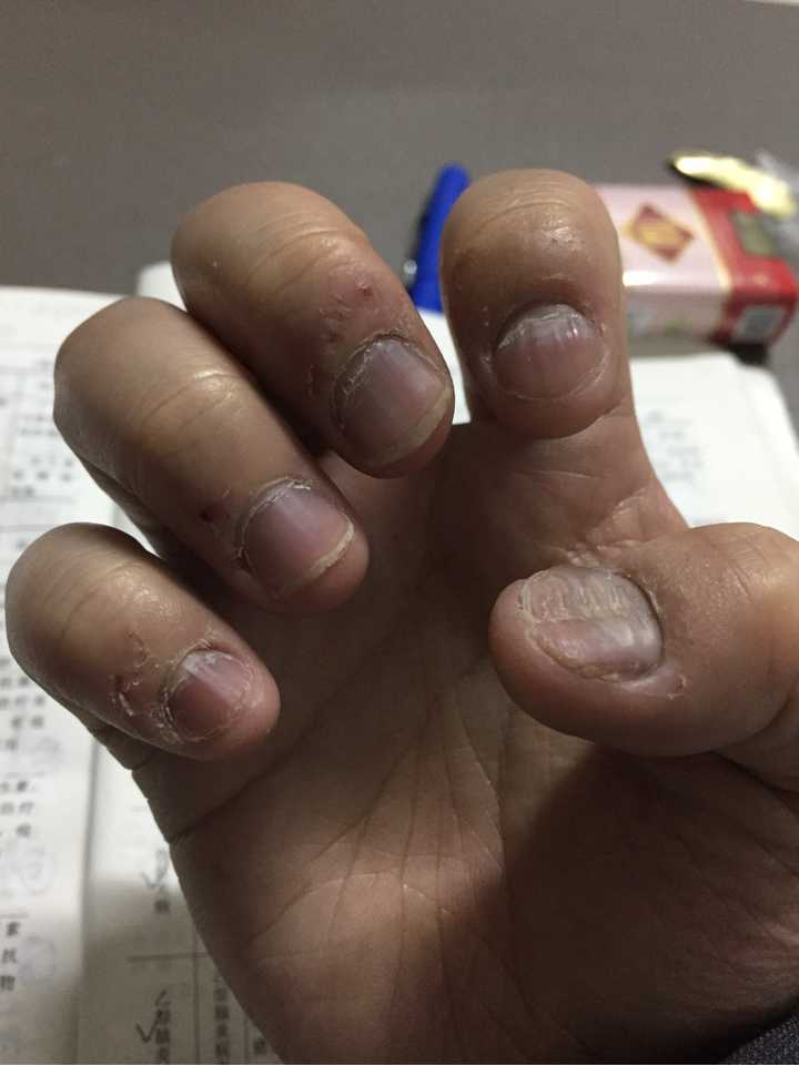 从小吃指甲,想留成和别人一样的指甲,可能吗?