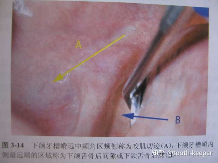 假牙很重要,它的界限是:内侧是剩余牙槽嵴,外侧是内斜嵴,近中是颊系带