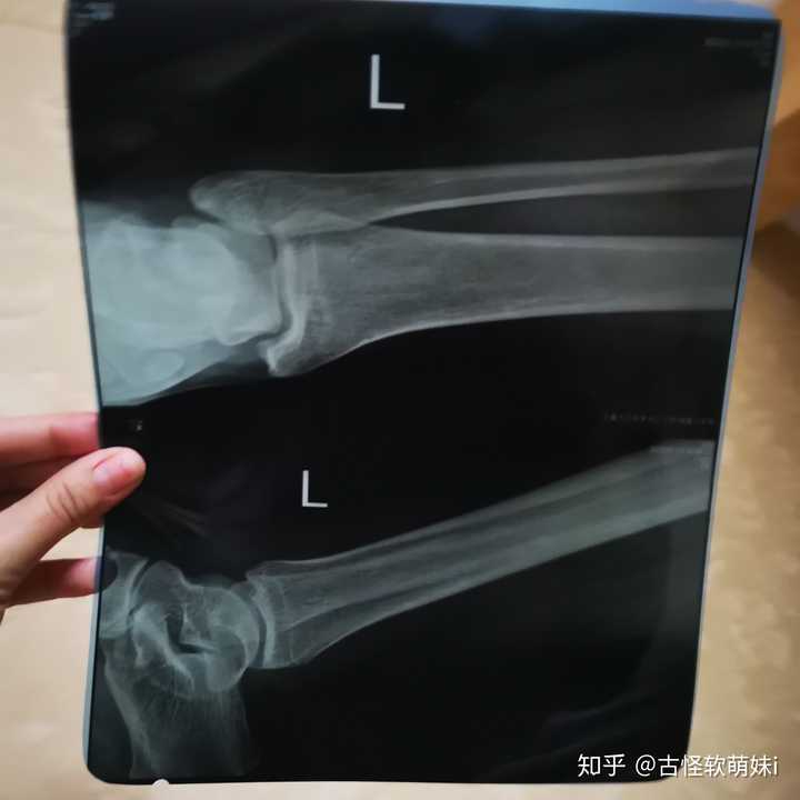 外踝骨折多久拆石膏?