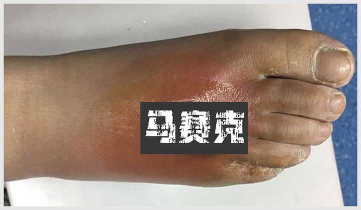 蜂窝织炎常见于小腿,单侧发作,部分感染者还伴有发热的症状.