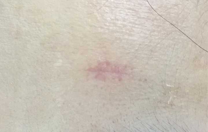 手术切痣疤痕图片