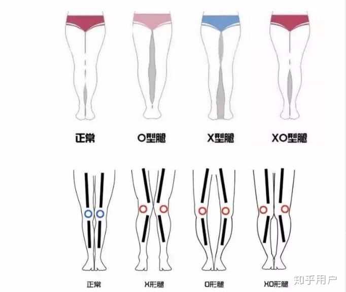 以及纠正腿型?