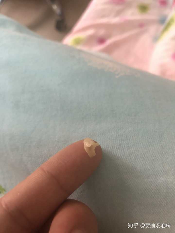 为什么我掏出来的耳屎是桶状的,就是一层薄膜粘附在耳