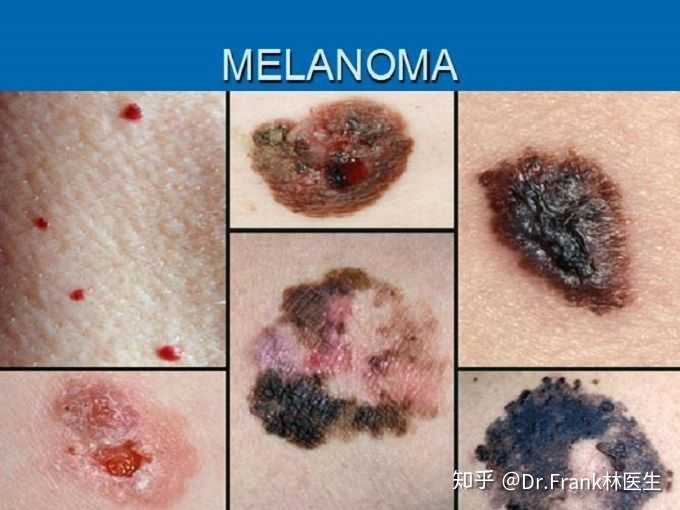 黑色素瘤(melanoma)是一种皮肤癌症,它始于黑色素细胞(melanocytes)