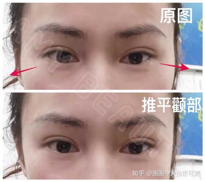 开眼角,眼睛变大是什么体验?