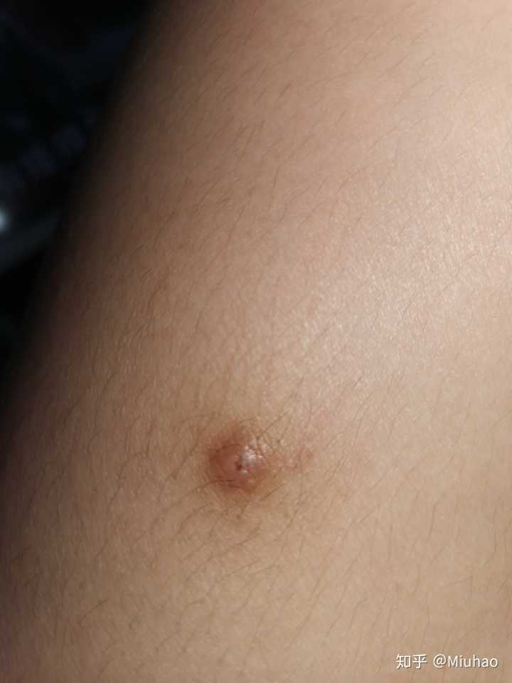 大腿上有颗黑痘痘有点硬好几年了是什么