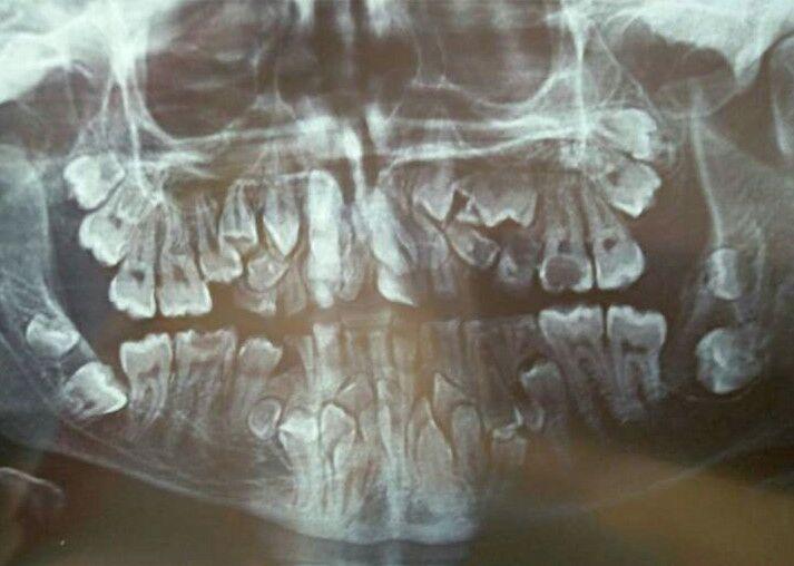 11岁小孩换牙时候的x光片,我看不出啥毛病,求大神来读片.