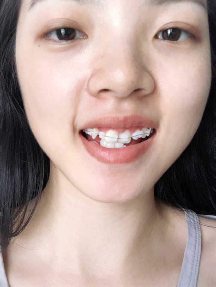 牙齿矫正对个人外貌变化有多大影响?
