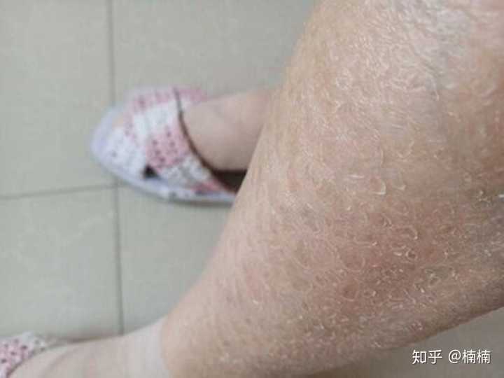 鸡皮肤怎么避免遗传下一代