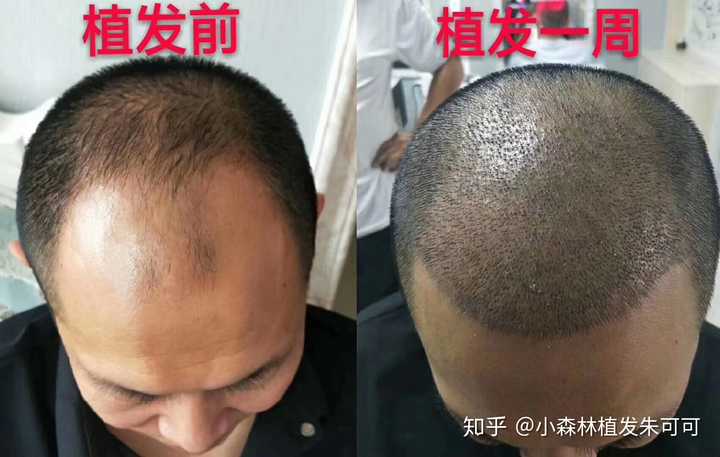 植发真的有用吗特别好奇?