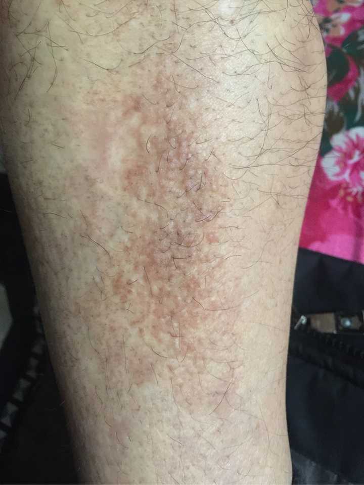 哪位大神知道我爸爸的腿上这是什么皮肤病?