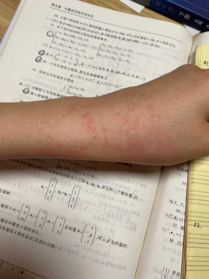 贴膏药过敏怎么办?