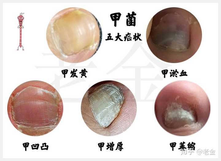 灰指甲初期症状,我这个是灰指甲吗?