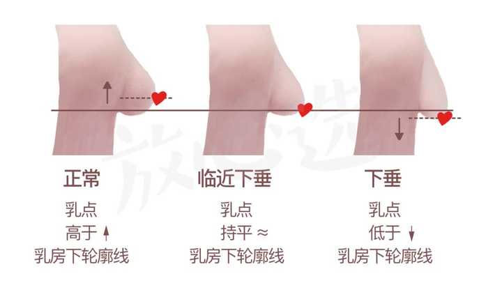 但实际上判断胸部是否下垂需要关注乳点与胸部下轮廓线的相对位置