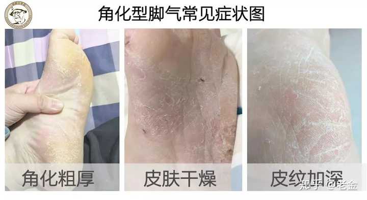 脚气脚气怎么治才能除根?