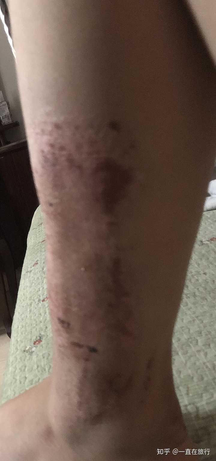 第二张是小腿车祸留的疤痕,植过皮,第三张是大腿取皮处还没有恢复