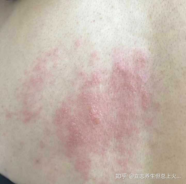 9月27日,第一次拍照,以为是过敏,同事说她妈之前得过带状疱疹,感觉跟
