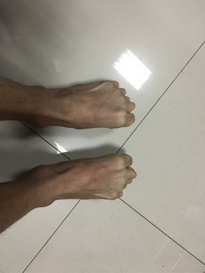 脚趾能否五指张开是基因差异吗