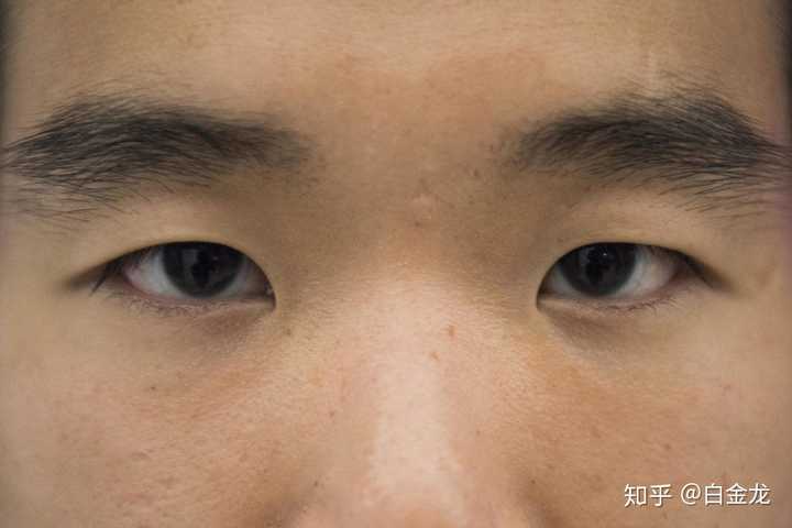 亚洲人眼睛小,是眼球本身小还是眼部皮肤差异造成的?
