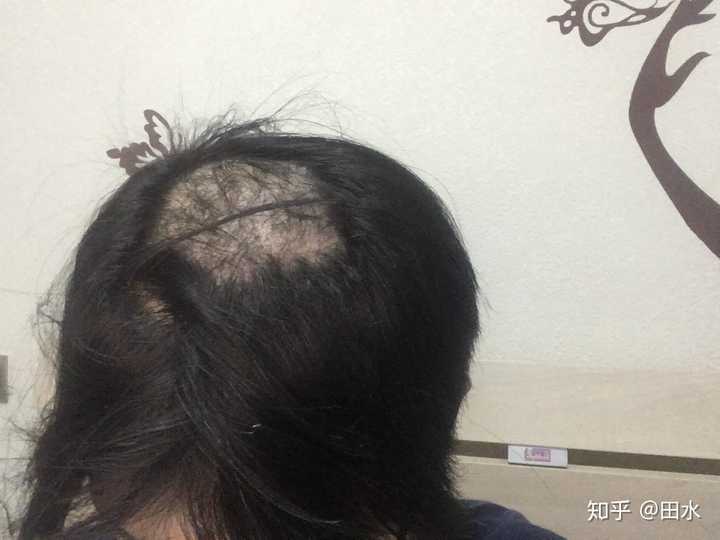 女生头顶头发少是什么体验 ?