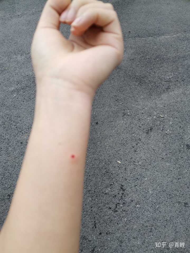 学校结核皮试,这样子是正常吗?