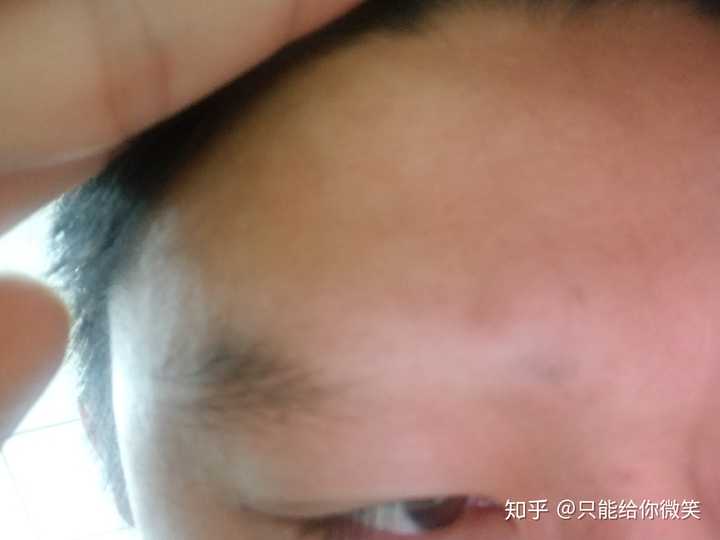 最近有点斑秃,越来越大了,怎么办?