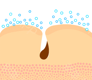 怎样可以祛黑头?