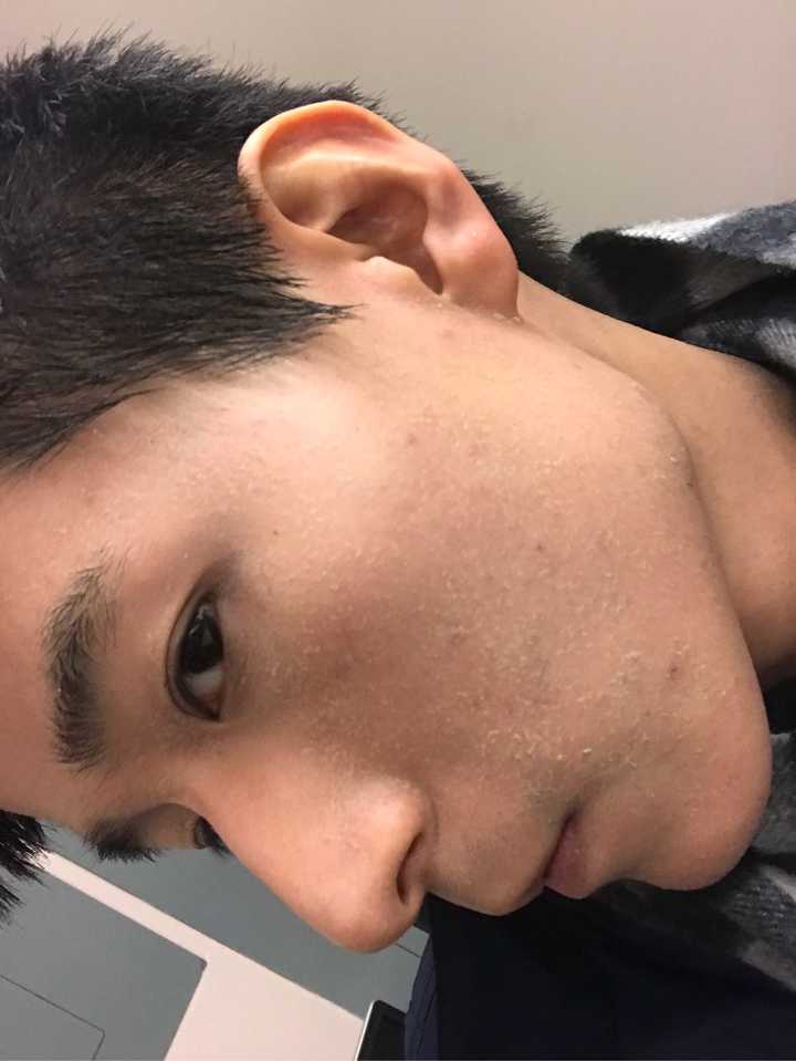 冬天脸干是一种什么样的体验?