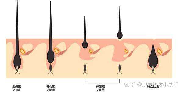 休止期脱发也会细软吗?