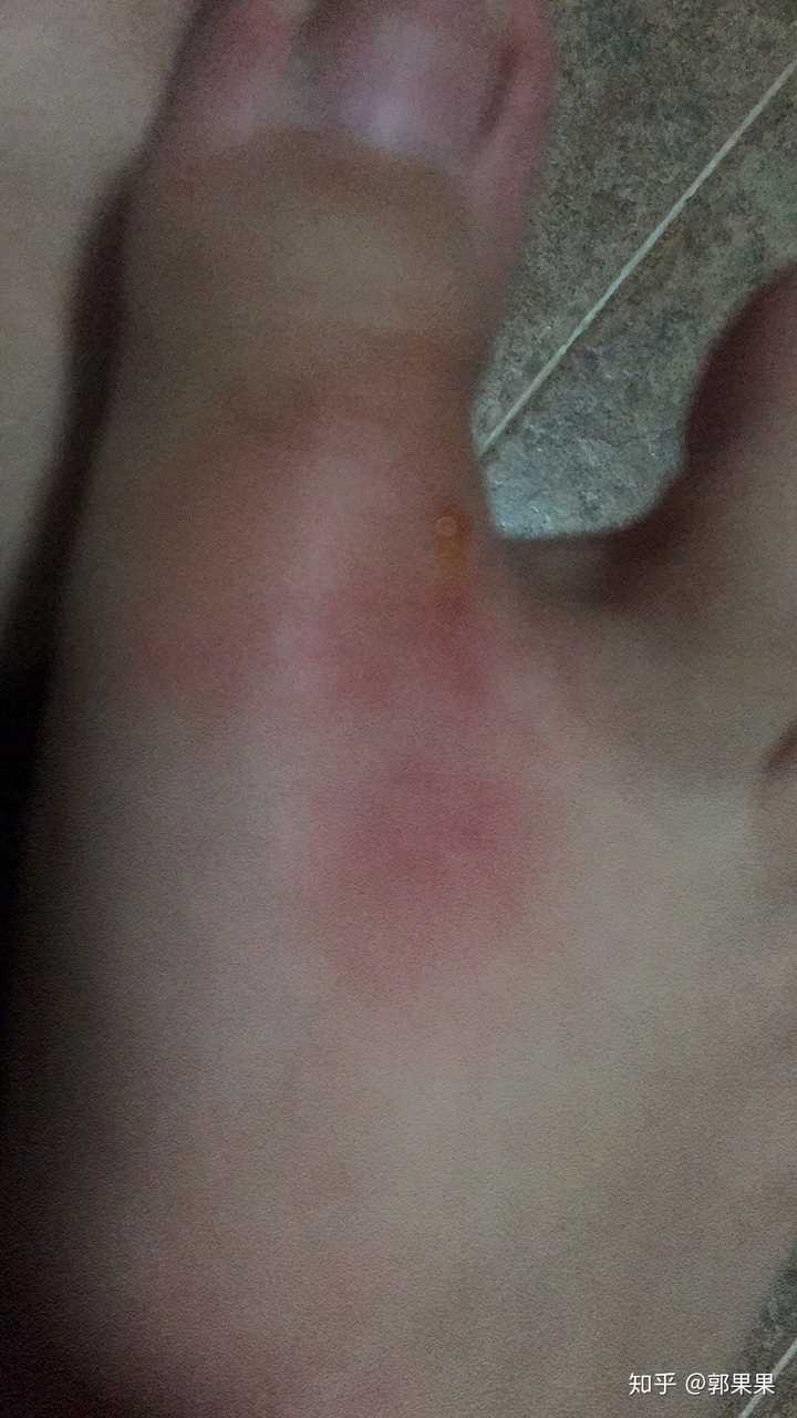 被跳蚤咬的全身都是包是什么样的感受!