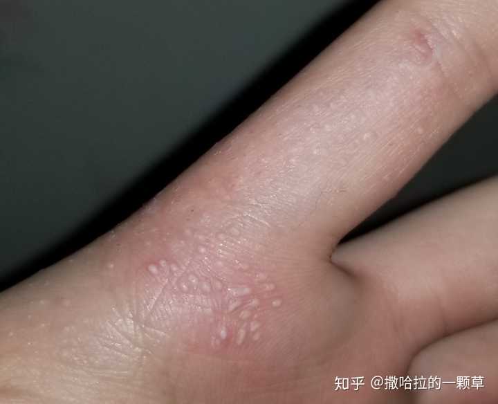 能不能说一下不小心摸到荨麻草的感觉?