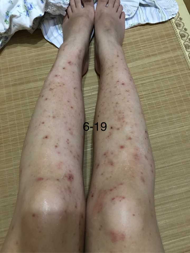 被蚊子咬了留下的疤怎么去除?