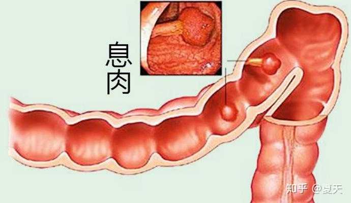 大三女生,去年查出巧囊,这几天又查出内膜息肉,感觉整个人生都是灰暗