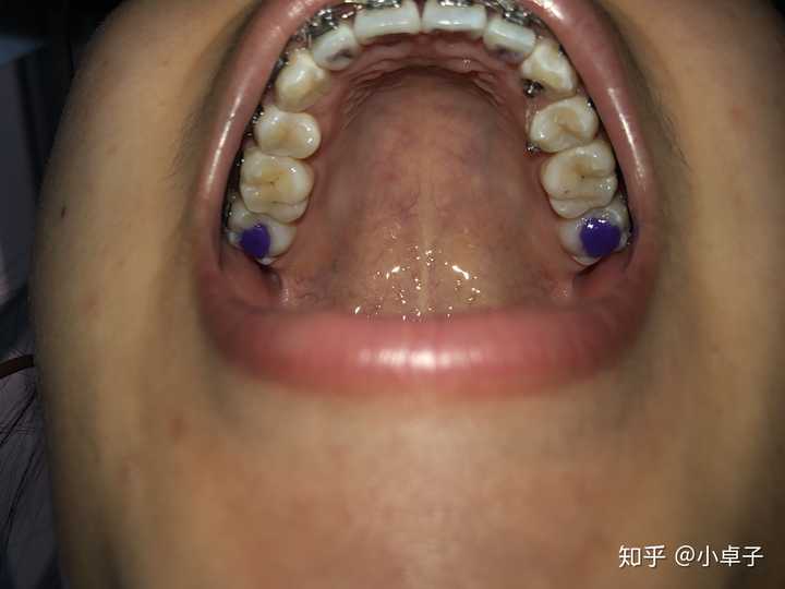 大龄男女青年牙齿正畸并拔牙的过程感觉