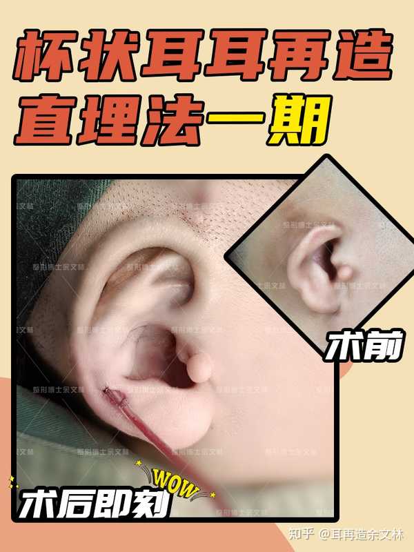 耳长轴缩短明显,耳廓上部向前卷曲下垂盖住耳道口,耳屏处存在副耳.