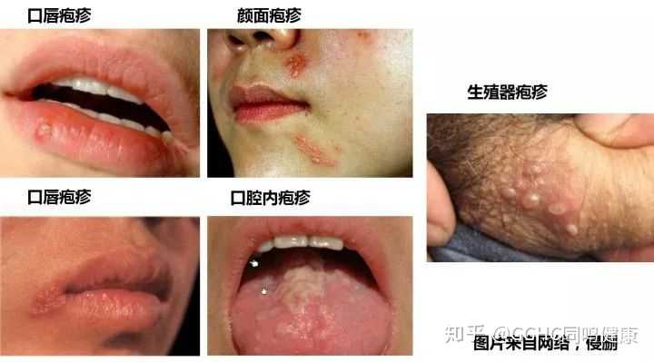 男朋友得了生殖器疱疹,我该怎么办?