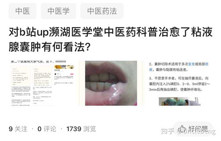 对b站up濒湖医学堂中医药科普治愈了粘液腺囊肿有何看法?