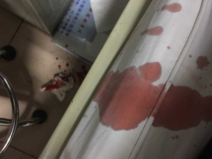 右鼻子较痛 不住出血 现在已经止血 等待大夫上班进一步检查.