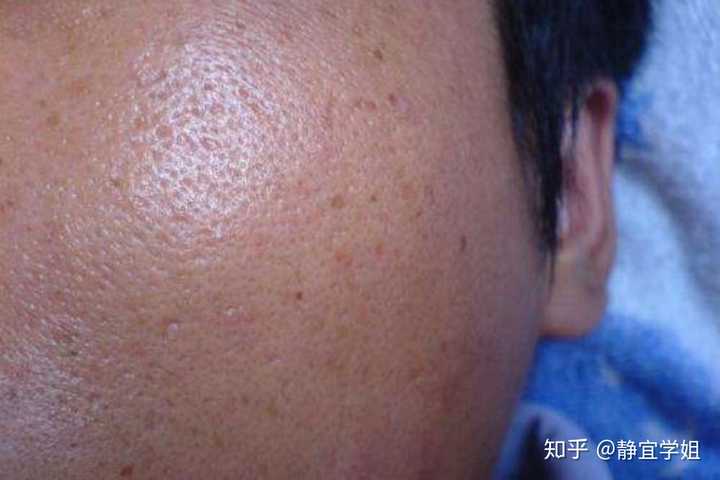 毛孔粗大之后真的不可逆吗?