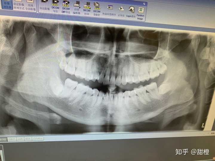 智齿横着长是一种怎样的体验?