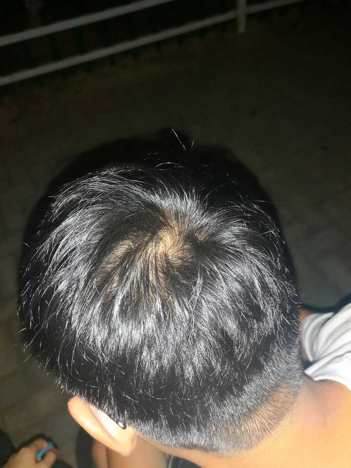 有一个秃头男朋友是一种什么体验?
