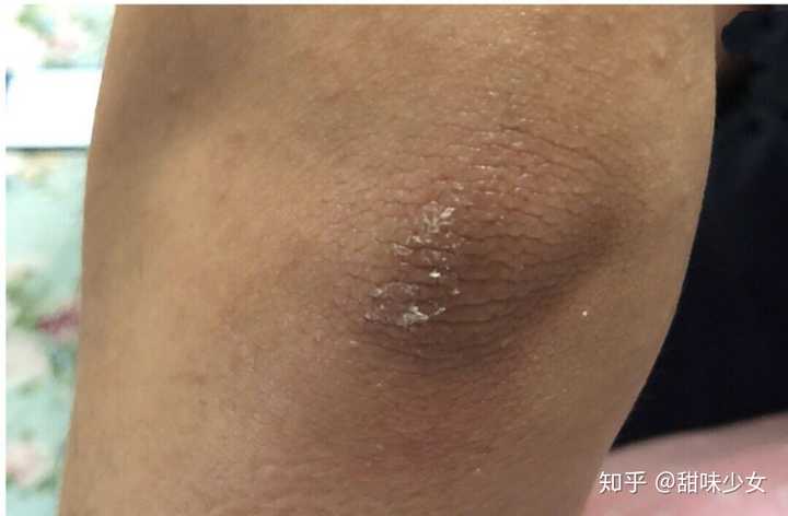 膝盖和手关节总是很黑如何解决?