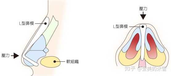假体硅胶隆鼻用不用耳软骨垫鼻尖有什么区别?有垫的必要性吗?
