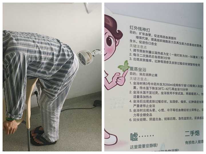经历痔疮手术是种怎样的体验?