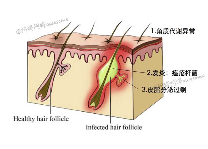 长痘痘的原因是什么?