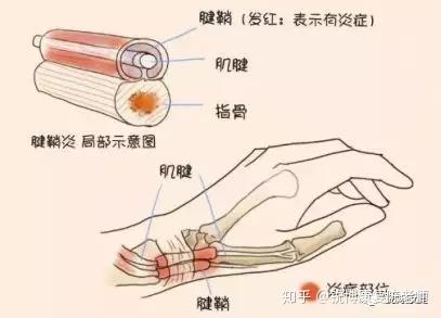 怎么可以治好腱鞘炎?